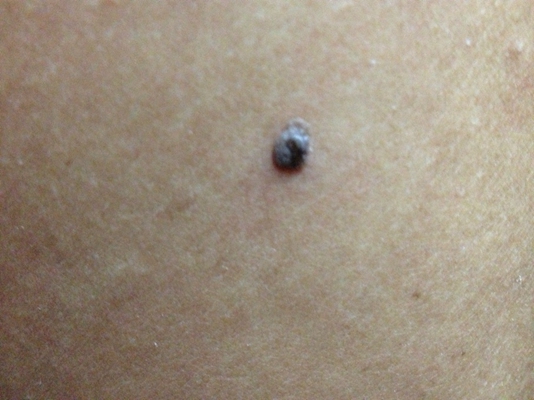 黑痣癌變
