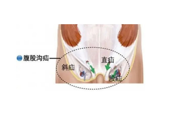 腹股溝斜疝 (61) 