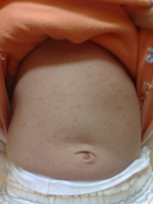 得了幼兒急診的寶寶 