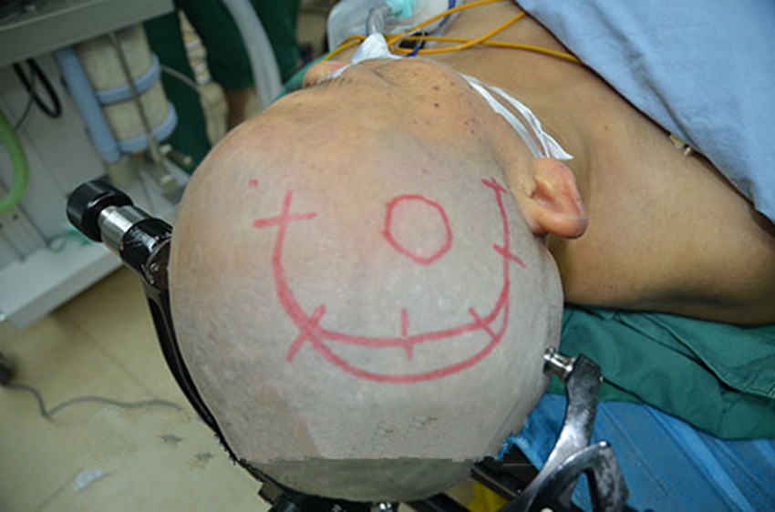 伽瑪刀治療腦膜瘤