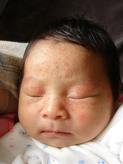 新生兒胎毒的症狀