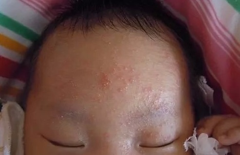 小兒急疹的症狀 (47) 