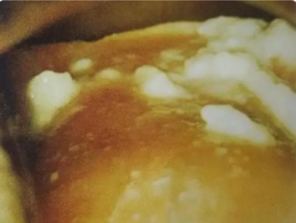 外陰潰瘍外部症狀的