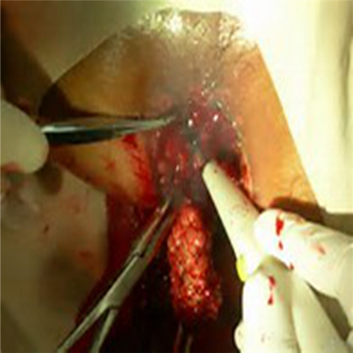 直腸息肉割除手術