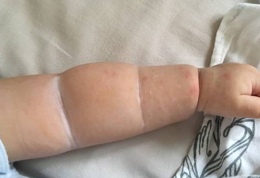 身體蟎蟲過敏症狀