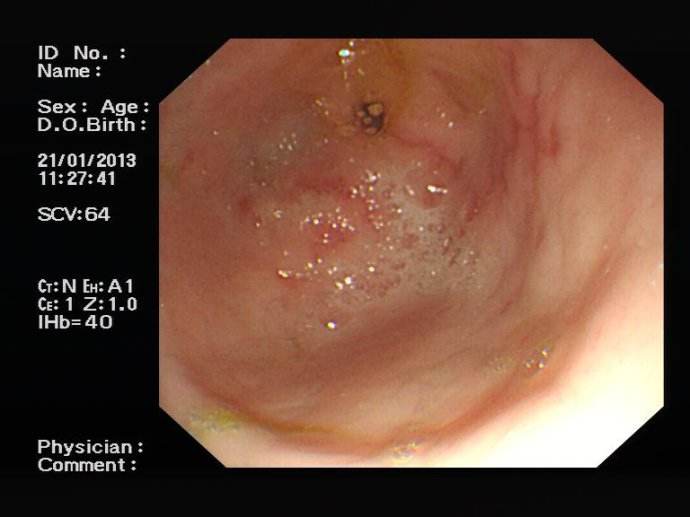 胃竇糜爛 (7) 