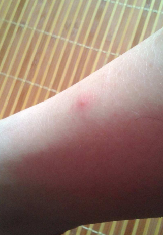 身體蟎蟲過敏症狀