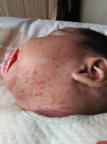 臉上皮膚過敏症狀