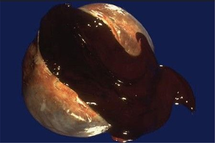 巧克力卵巢囊腫什麼樣