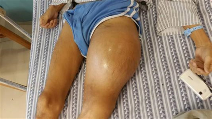 左腿的骨肉瘤高清