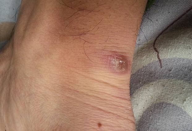 慢性淋巴結炎 (46) 