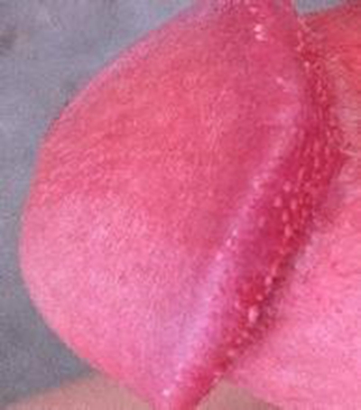 性病性淋巴肉芽腫套圖 (41) 