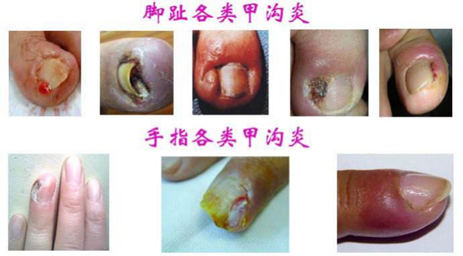 甲溝炎的診斷和鑑別甲周炎的