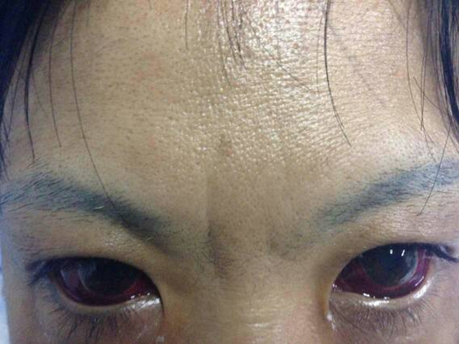 新生血管性青光眼等眼部