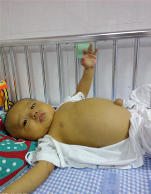 小孩患有了腹水