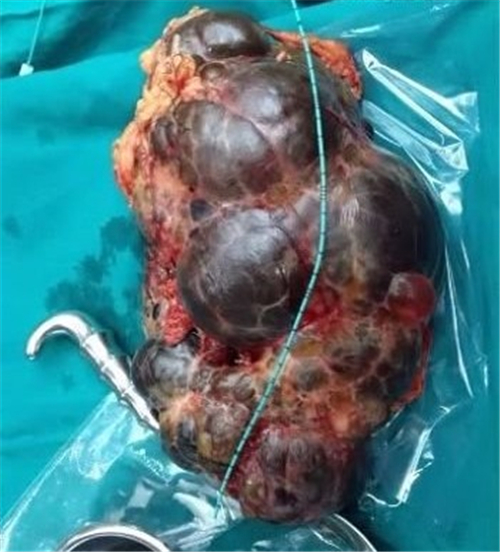 腎囊腫引起腎巨大