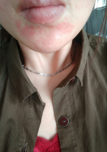 臉上皮膚過敏症狀