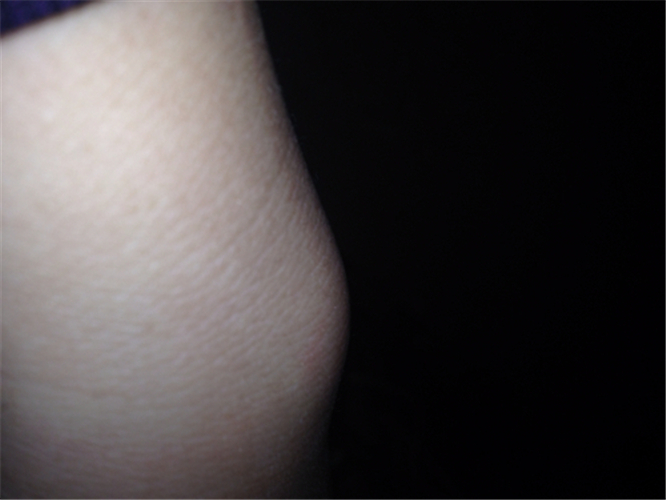 左手手腕腱鞘炎的