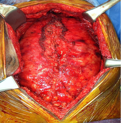 硬膜下血腫 (49) 