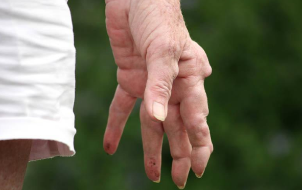 靜止性震顫 (63) 