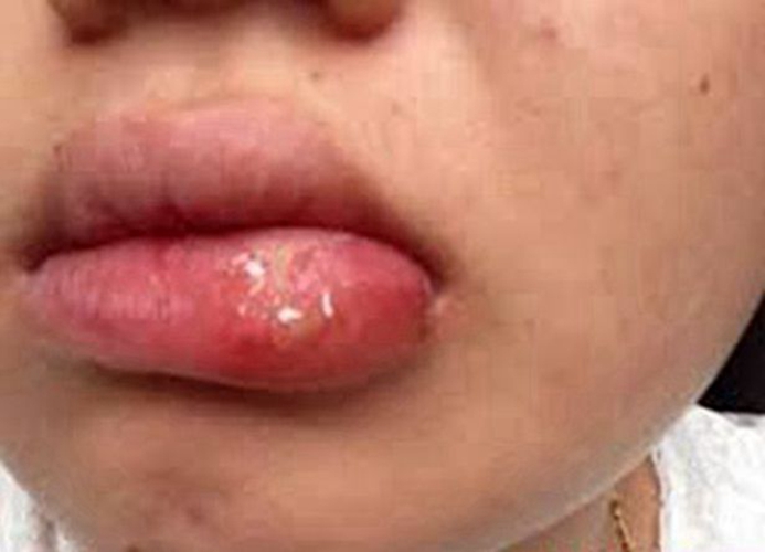 口唇皰疹腫大