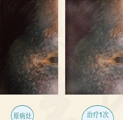 第一次治療太田痣