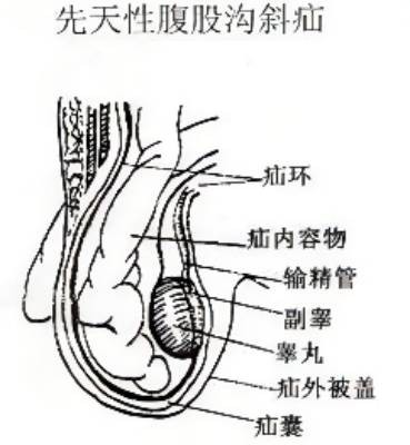 腹股溝斜疝 (58) 
