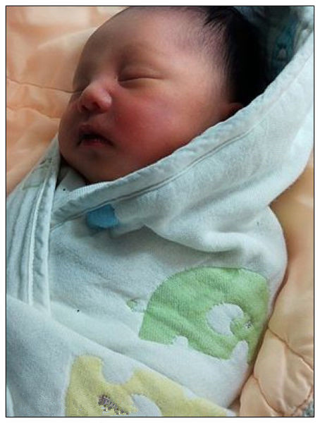 右痙攣性斜頸正確睡姿