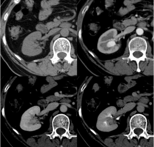 糖尿病腎病細胞
