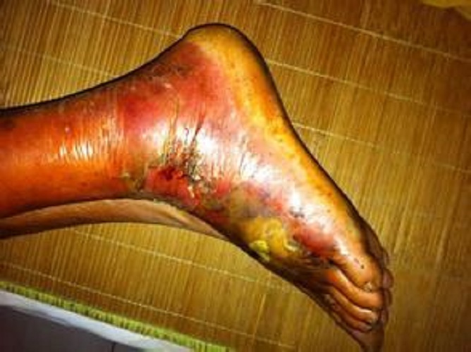 足部破傷風症狀