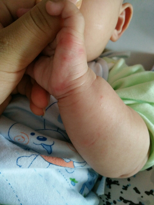 手部溼疹過程的