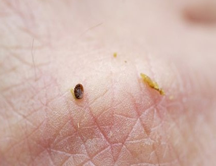 身體蟎蟲過敏症狀