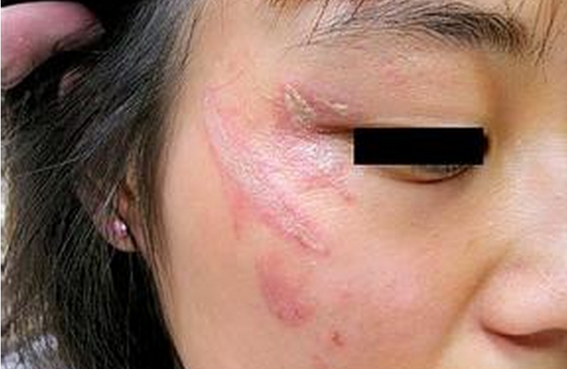 隱翅蟲皮炎眼角