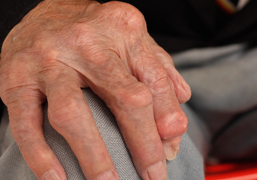 靜止性震顫 (53) 