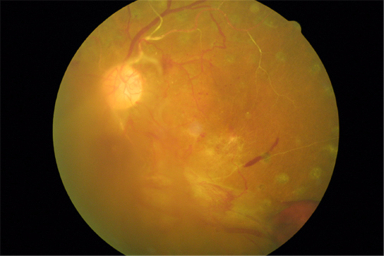 嚴重的視網膜脫落