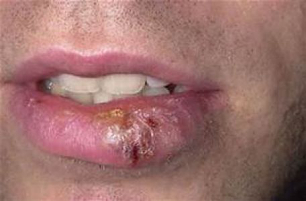 嘴上長皰疹 (47) 