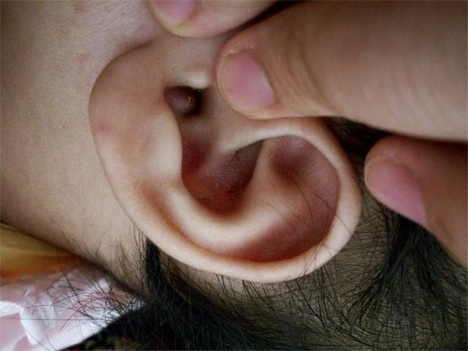 嬰幼兒侷限性外耳道炎