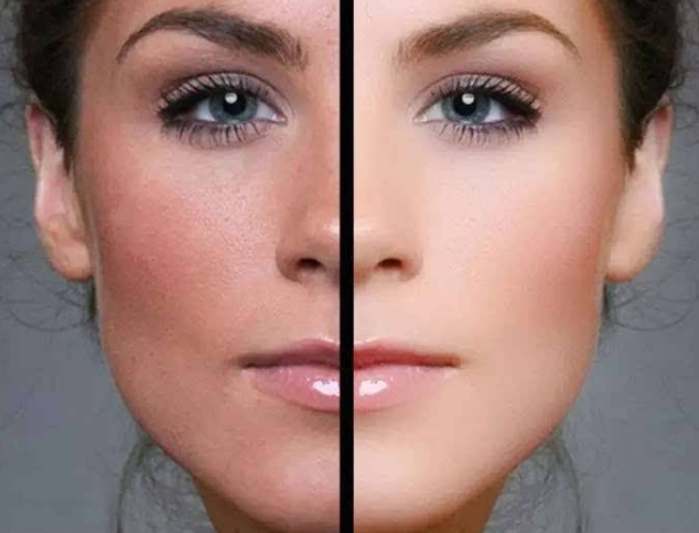 磨皮手術效果圖 (51) 