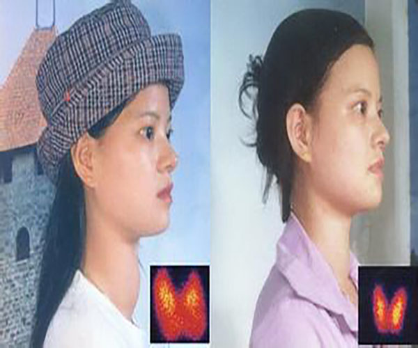 自主功能性甲狀腺瘤