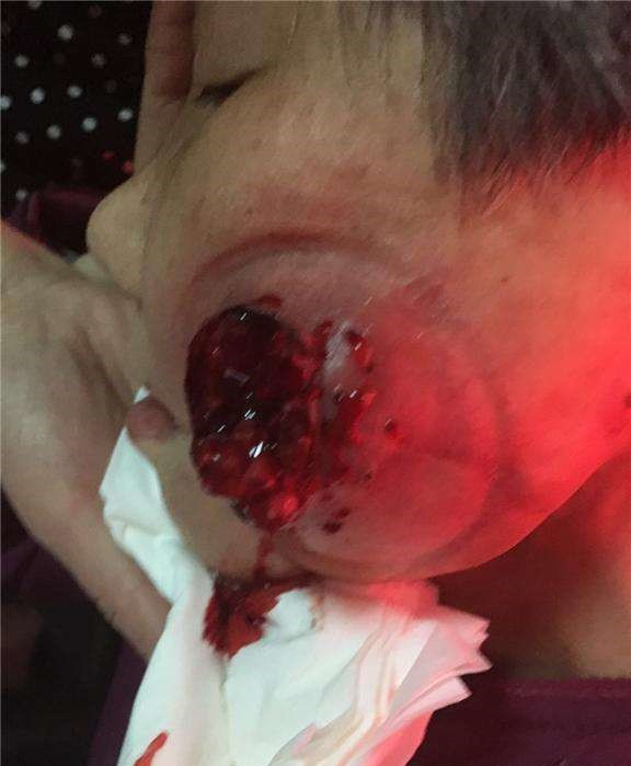 治療頰癌火針療法