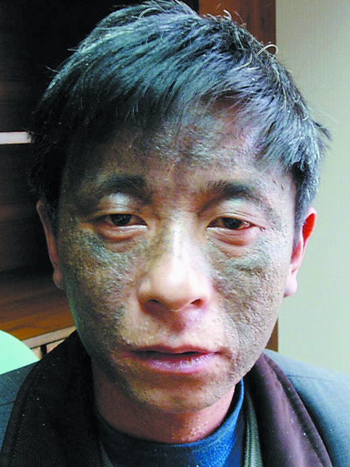 職業性皮膚黑變病晚期