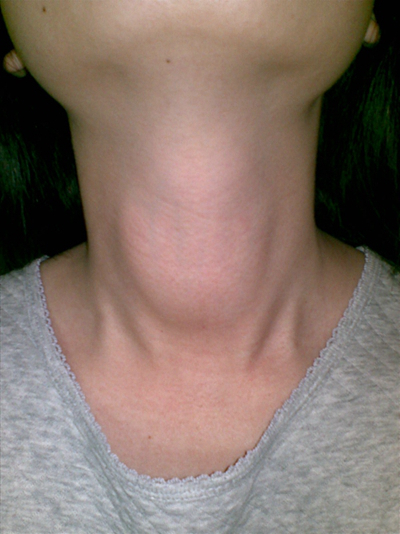 頜下淋巴結腫大