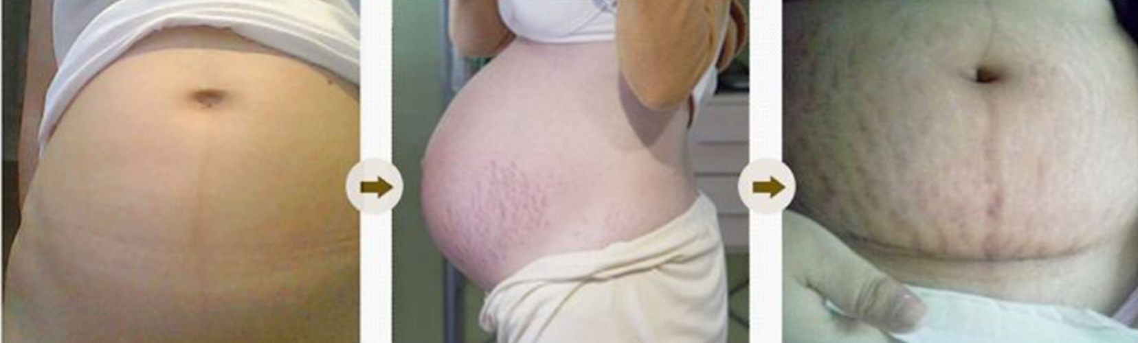 懷孕期的妊辰紋