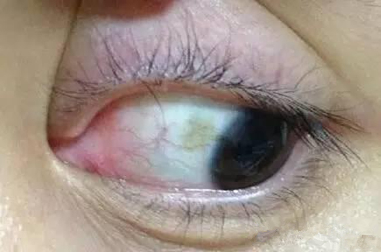 蛔蟲病症狀眼部