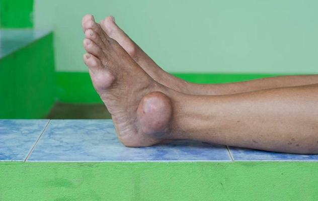 腳骨頭突出 (44) 