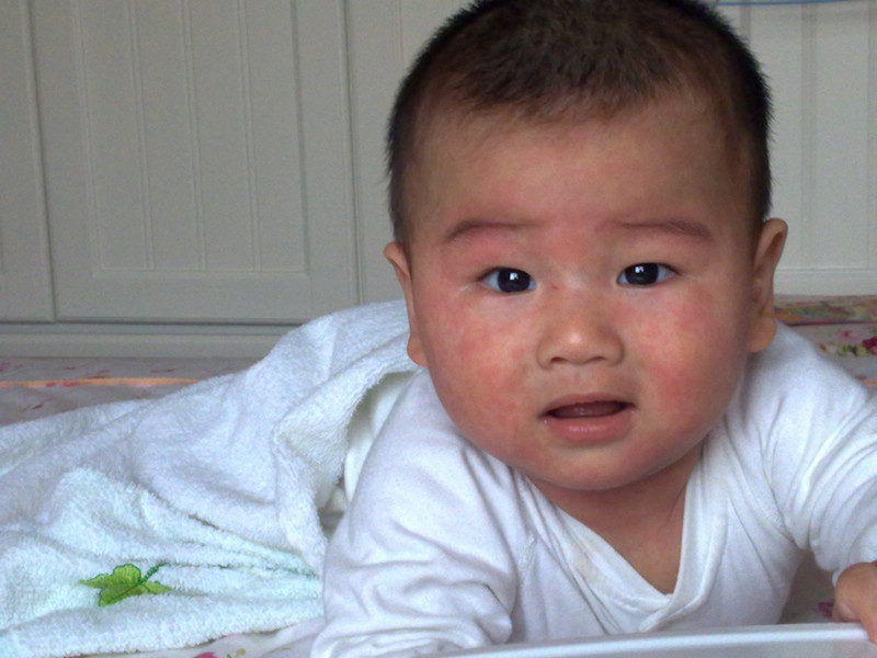 小兒急疹的症狀 (7) 