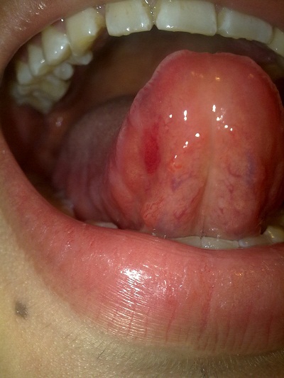 口腔癌的前兆 (51) 