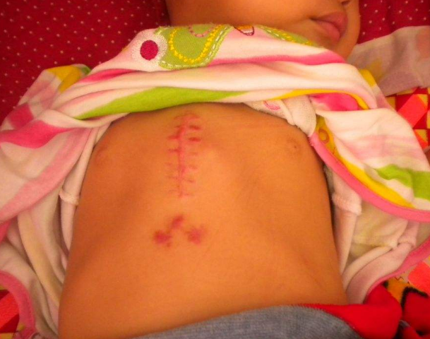 寶寶缺鈣雞胸圖 (9) 