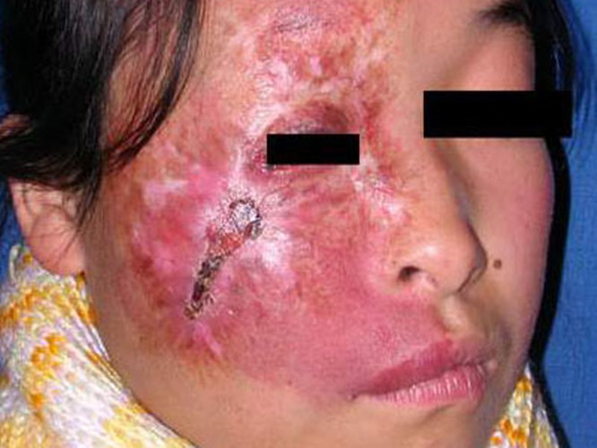 嚴重的面部放射性皮炎