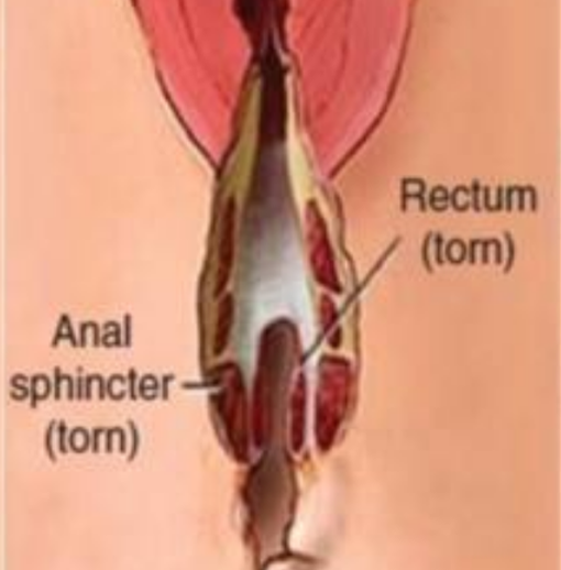 女性近期會陰撕裂縫和